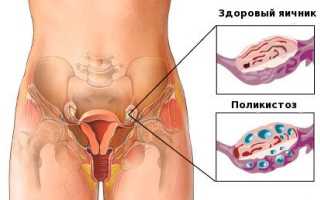 Поликистоз яичников