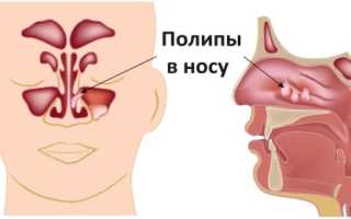Полипы в носу