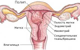 Что такое эелезисто-фиброзный полип эндометрия и лечение после удаления