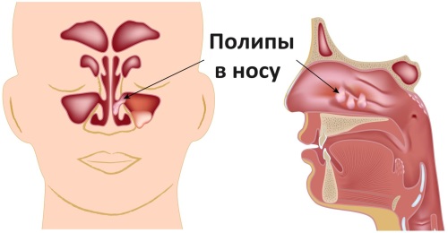причины проявления полипов в носу.