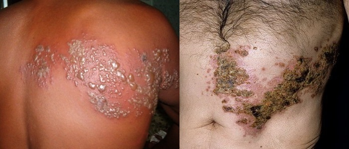 Симптомы проявления опоясывающего герписа