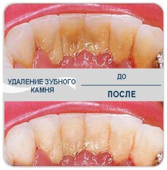 Удоление, лечение зубного камня.