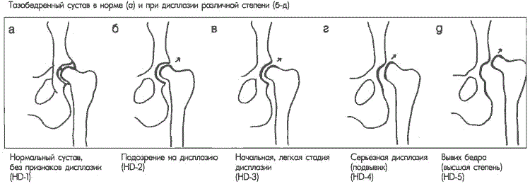 Стадии проявления дисплазии тазобедренного сустава