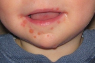 Симптомы и признаки проявления энтеровирусной инфекции у детей.