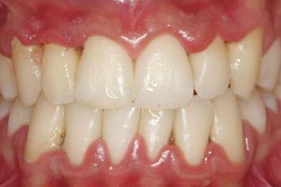 Фото проявления гингивита у взрослого человека
