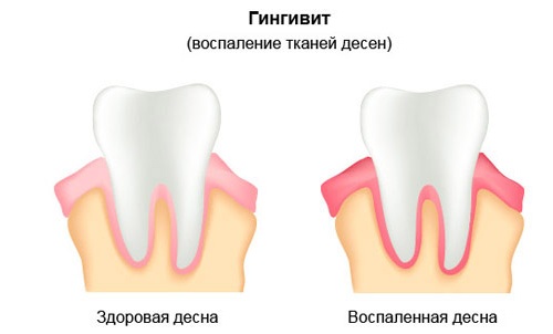 Виды и формы проявления заболевания десен.