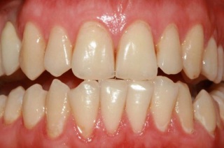 Причины возникновения гингивита.