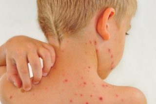 Проявление красных пятен на коже у ребенка