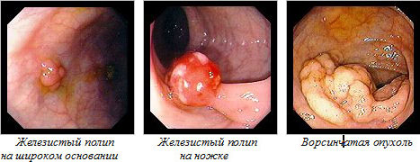 Классификация полипов толстой кишки
