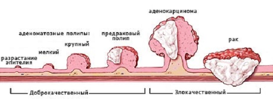 Опасность появления полипа.