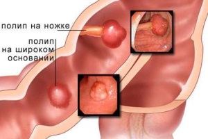 Причины появления полипов.