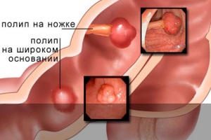 Причины появления полипов в желудке.