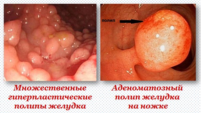 Проявления полипов в желудке.
