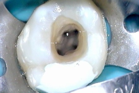 Фото пульпита зуба у взрослого человека