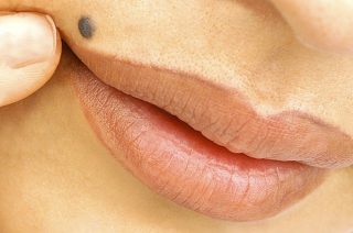 Причины проявления и методы лечения рака кожи