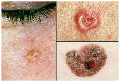 Проявление и виды рака кожи