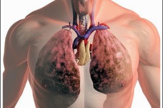 Диагностика и лечение рака легких