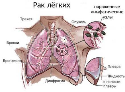 Причины и симптомы проявления рака легких