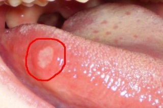 Причины проявления рака на языке.