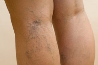 Причины и симптомы проявления варикозного расширения вен ног и его профилактика