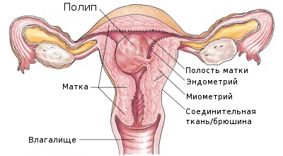 Что такое железисто фиброзный полип эндометрия?
