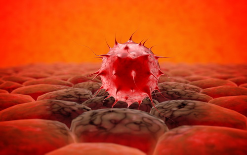 Лечение миеломы в Германии