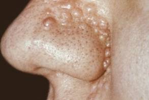 Аденома: фото и характеристика