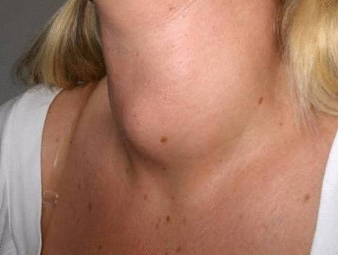 Аденома: фото и характеристика