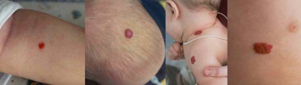 Ангиома у детей