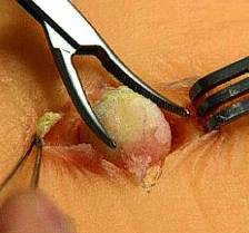 атерома операция