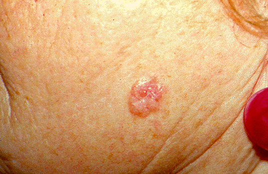 bazalioma kozhi lica