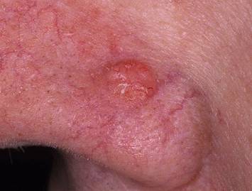 Базалиома носа - фото