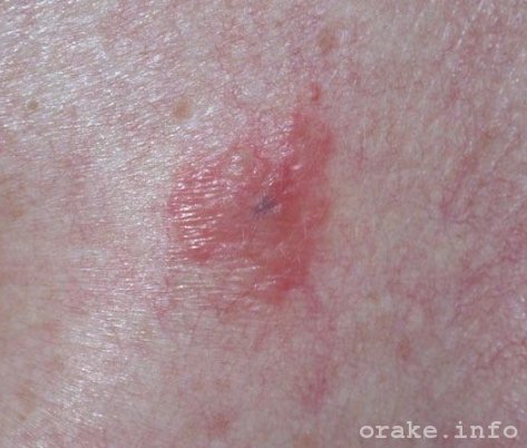 bescvetnaya melanoma