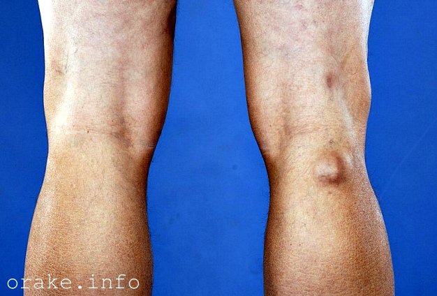 chem opasna kista bejkera