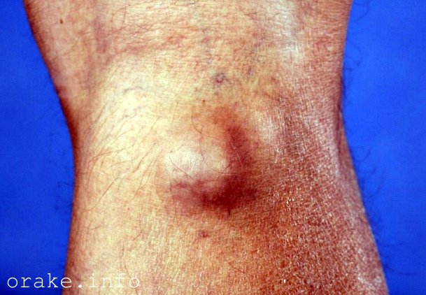 chem opasna kista podkolennoj yamki