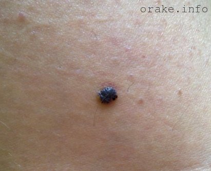 черная родинка на теле