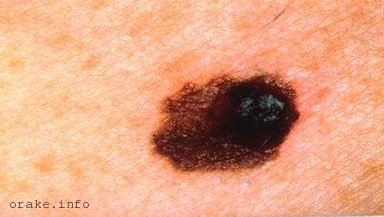 черная родинка