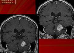 Доброкачественная опухоль мозга