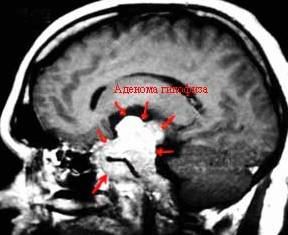 Доброкачественная опухоль мозга