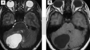 Доброкачественная опухоль мозга