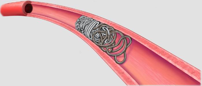 embolizaciya miomy matki