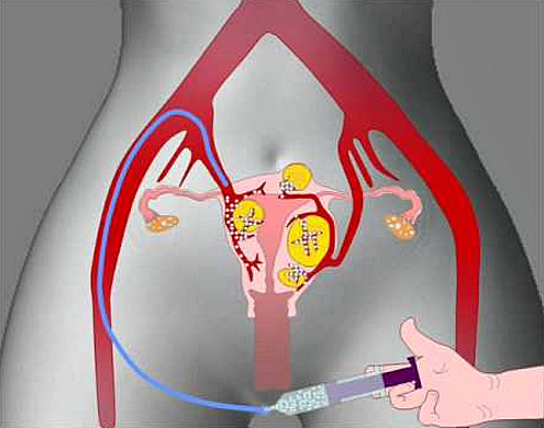 embolizaciya miomy