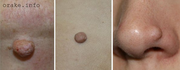 фиброма кожи