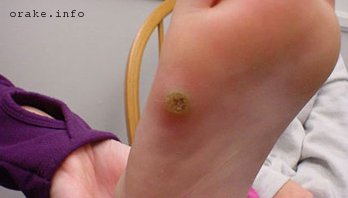 фиброма под кожей