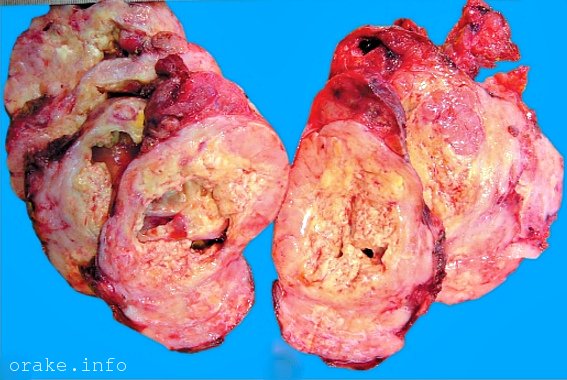 follikulyarnyj rak shhitovidnoj zhelezy