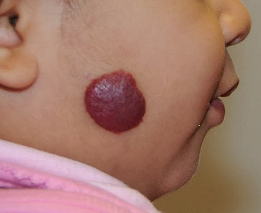 gemangioma-u-detej