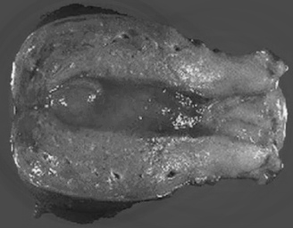 giperplaziya endometriya