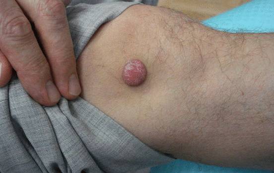 Гистиоцитома: симптомы, причины, лечение и прогноз