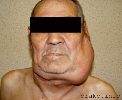 kak vyglyadit limfoma berkitta