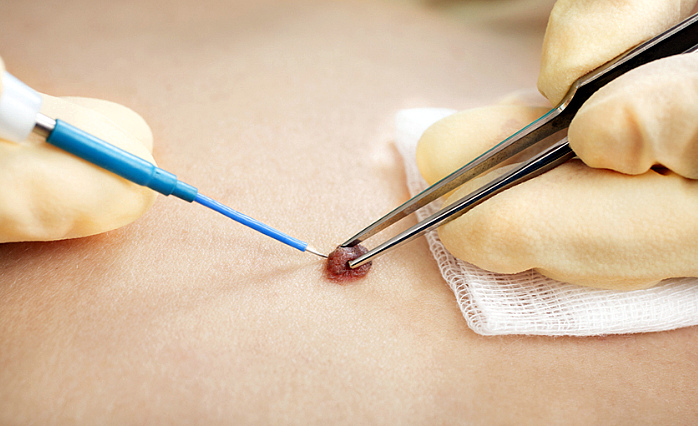 kakie rodinki nuzhno udalyat